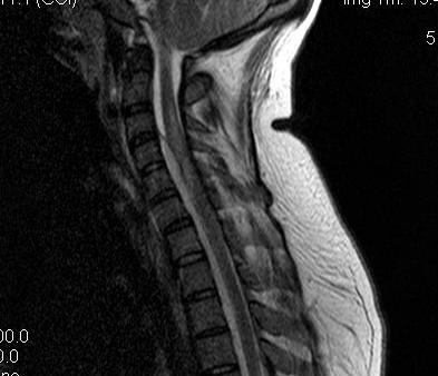 Cervical Epidural Abscess T1 MRI